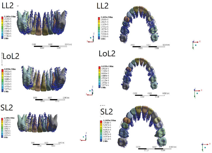 Stress Distribution and Tooth Displacement Analysis of Maxillary Molar Distalization by Different Designs of Jig in a Finite Element Study.