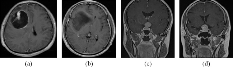 Brain tumor intelligent diagnosis based on Auto-Encoder and U-Net feature extraction.