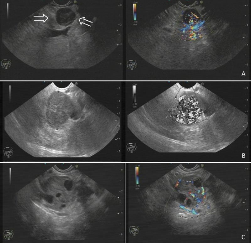 The role of artificial intelligence and deep learning in determining the histopathological grade of pancreatic neuroendocrine tumors by using EUS images.