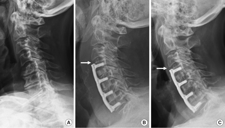 Risk Factors for "Adjacent-Level Ossification Development" Other Than Short Plate-to-Disc Distance and Clinical Implications for Adjacent-Segment Pathology.