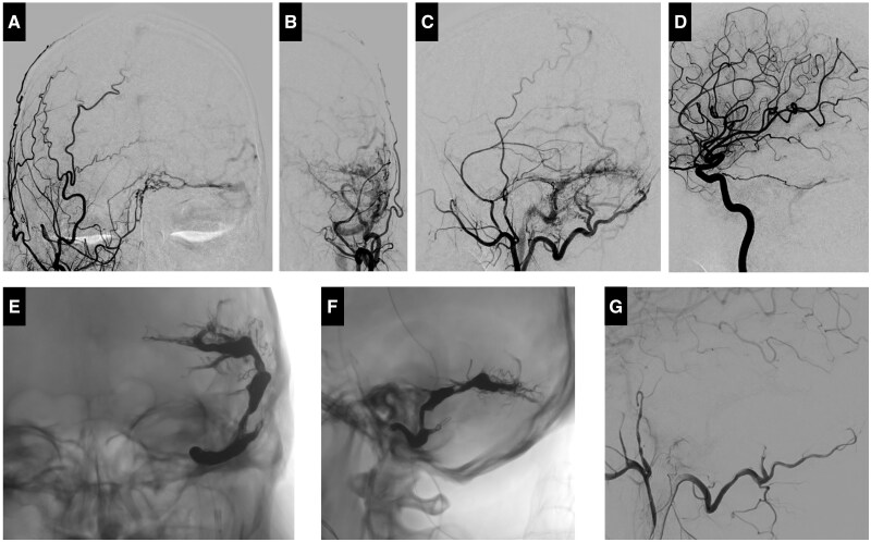Unexpected vasogenic oedema and alexia as complications after dural arteriovenous fistula embolization.