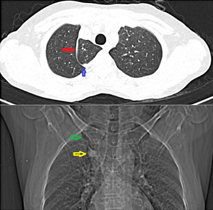 Azygos lobe-a rare anatomical variant.