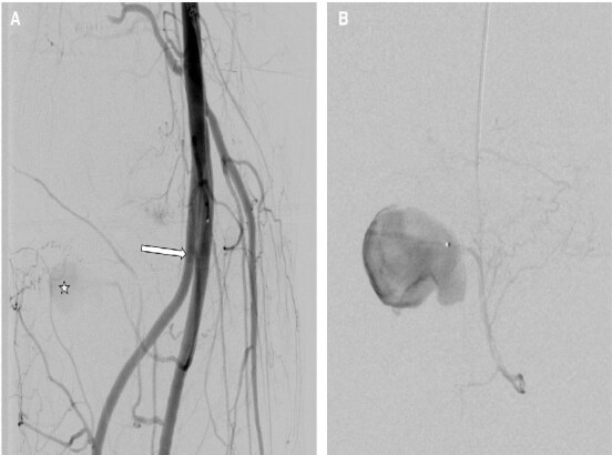 Endovascular treatment of a pseudoaneurysm in the right inferomedial genicular artery after arthroscopic anterior cruciate ligament reconstruction: a case report.