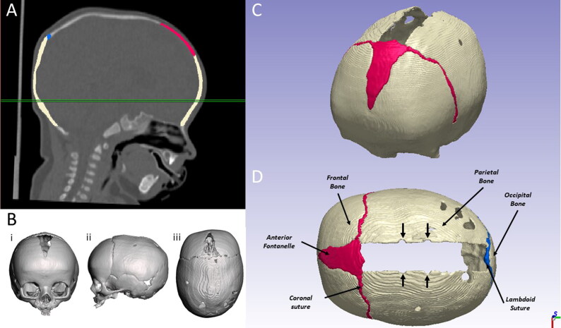 Towards a radiation free numerical modelling framework to predict spring assisted correction of scaphocephaly.