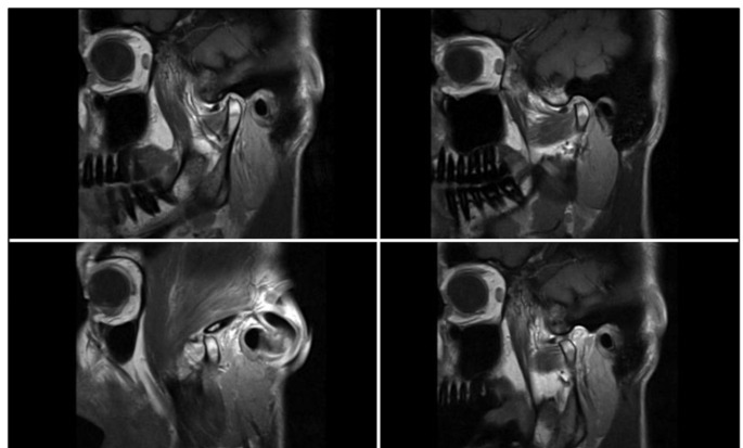 Can provision of additional arthroscopic video material improve accuracy of assessment of temporomandibular joint disorders by dental Non-experts vs. MRI alone: An exploratory study in 3rd to 5th year German dental students.