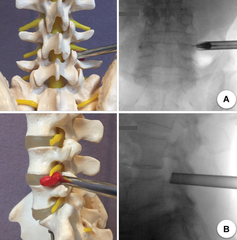 Transforaminal Percutaneous Endoscopic Discectomy for L3/4 and L4/5 Foraminal and Extraforaminal Lumbar Disc Herniation: Clinical Outcomes and Technical Note.