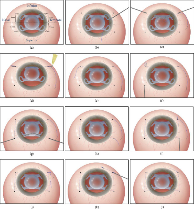 The Suture-In-Needle, Closed-Loop Technique for Repositioning a Dislocated Akreos Adapt Intraocular Lens.