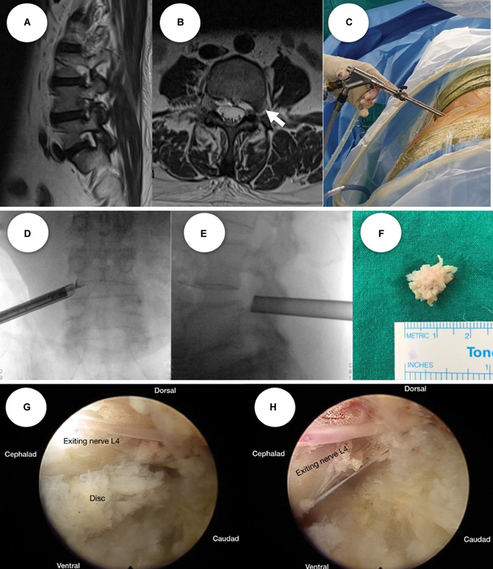 Transforaminal Percutaneous Endoscopic Discectomy for L3/4 and L4/5 Foraminal and Extraforaminal Lumbar Disc Herniation: Clinical Outcomes and Technical Note.