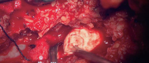 Cement-Augmented Pedicle Screw Fixation in Patients with Osteoporosis : Safety, Efficacy and Complications.