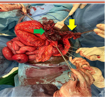 Post-Traumatic Diaphragmatic Hernia Presenting as Bowel Obstruction 12 Years After a Chest Gunshot Wound: A Rare Delayed Diagnosis.