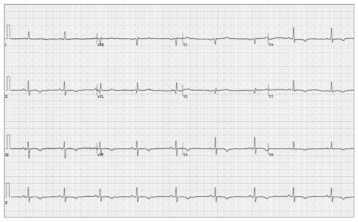What We May not Know: Torsades de Pointes Induced by Cannabinoid Use.
