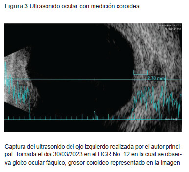 [Peripheral ulcerative keratitis with necrotizing scleritis, manifestation of granulomatosis with polyangiitis].