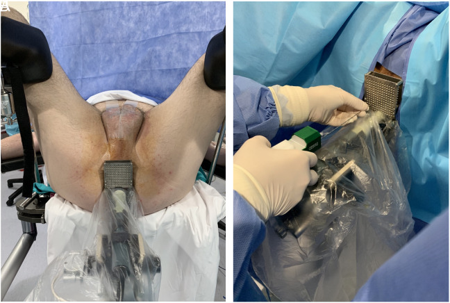 Freehand Transperineal Prostate Biopsy Improves the Detection Rate of Clinically Significant Prostate Cancer.