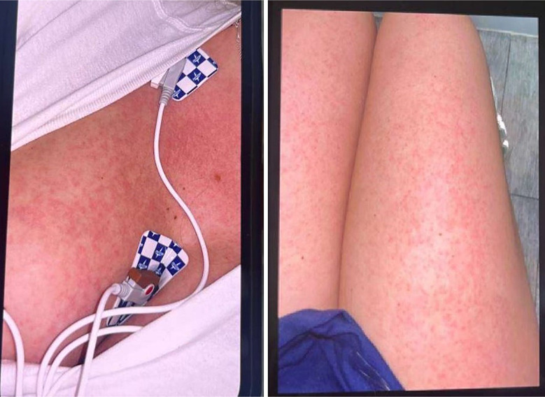 Drug Reaction with Eosinophilia and Systemic Symptoms Syndrome following Dalbavancin and Oritavancin Administration in a Patient with Osteomyelitis.