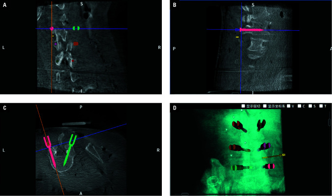 Percutaneous endoscopic lumbar partial laminectomy assisted by a new miniature parallel surgical robot system: a trial on a cadaveric specimen.