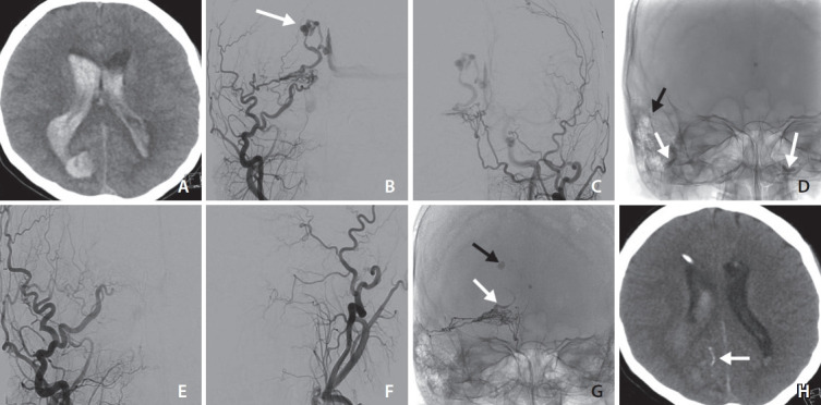 Hemodynamic Instability during Squid Embolization of Dural Arteriovenous Fistula: A Case Report.