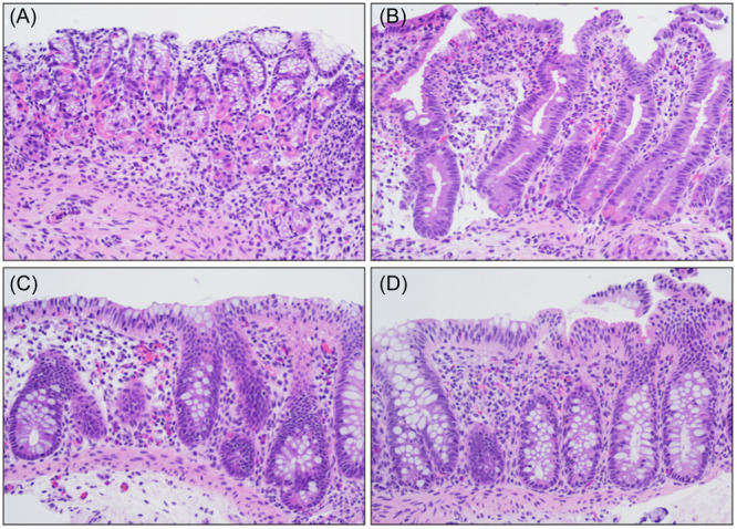 Carbohydrate malabsorption mimicking immune dysregulation: A histological challenge.