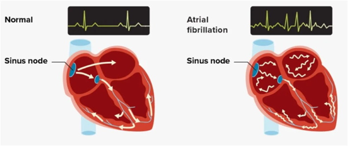 How Can Podiatrists and Other Health Care Professionals Support the Detection of Atrial Fibrillation?