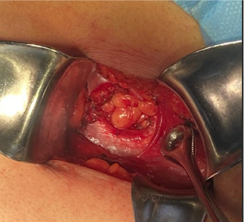 Clinical Presentation and Surgical Management of a Grynfelt Hernia: Report of a Clinical Case and Literature Review.