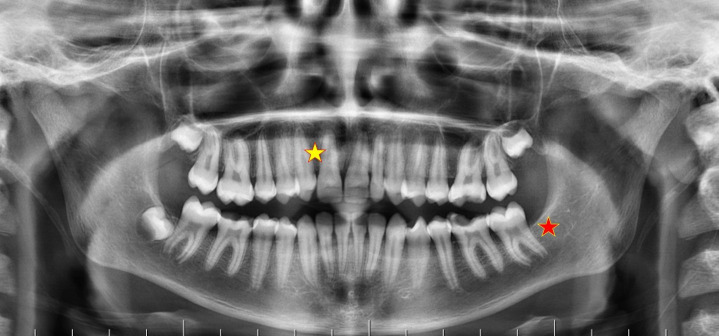 Retrospective Evaluation of Tooth Agenesis in Different Regions of Turkey with Panoramic Radiography.