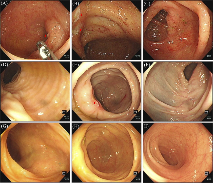 Case report: Alectinib-associated intestinal ulceration and colitis in a patient with non-small cell lung cancer and effective treatment with Mesalazine.