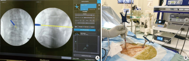 The Utilization of Navigation and Emerging Technologies With Endoscopic Spine Surgery: A Narrative Review.