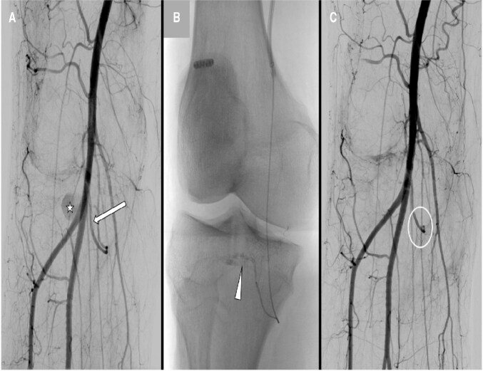 Endovascular treatment of a pseudoaneurysm in the right inferomedial genicular artery after arthroscopic anterior cruciate ligament reconstruction: a case report.