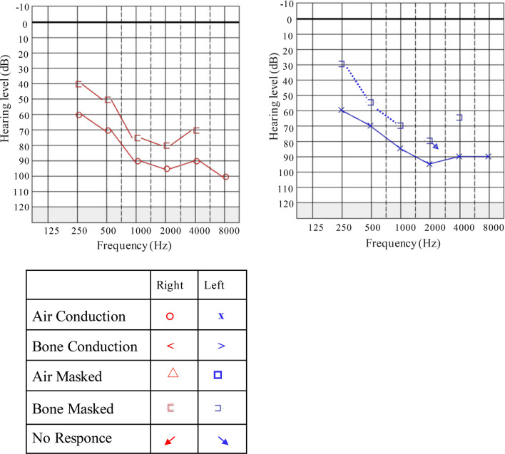Identification of novel CDH23 heterozygous variants causing autosomal recessive nonsyndromic hearing loss.