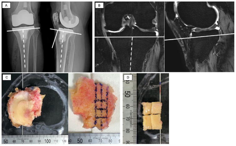 Ultra-Short Echo Time-MRI T2* Mapping of Articular Cartilage Layers Is Associated with Histological Early Degeneration.