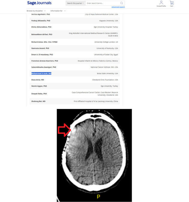 Calvarial Chondroplastic Osteosarcoma With Distant Brain Metastasis Treated With Radiosurgery: A Rare Case Report.