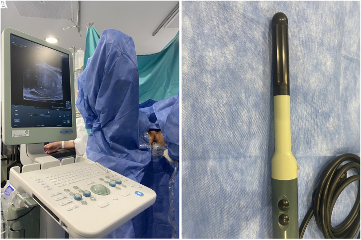 Freehand Transperineal Prostate Biopsy Improves the Detection Rate of Clinically Significant Prostate Cancer.