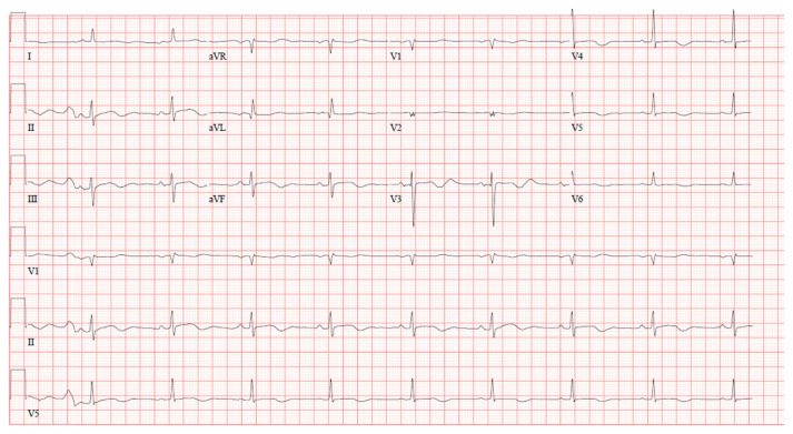 What We May not Know: Torsades de Pointes Induced by Cannabinoid Use.