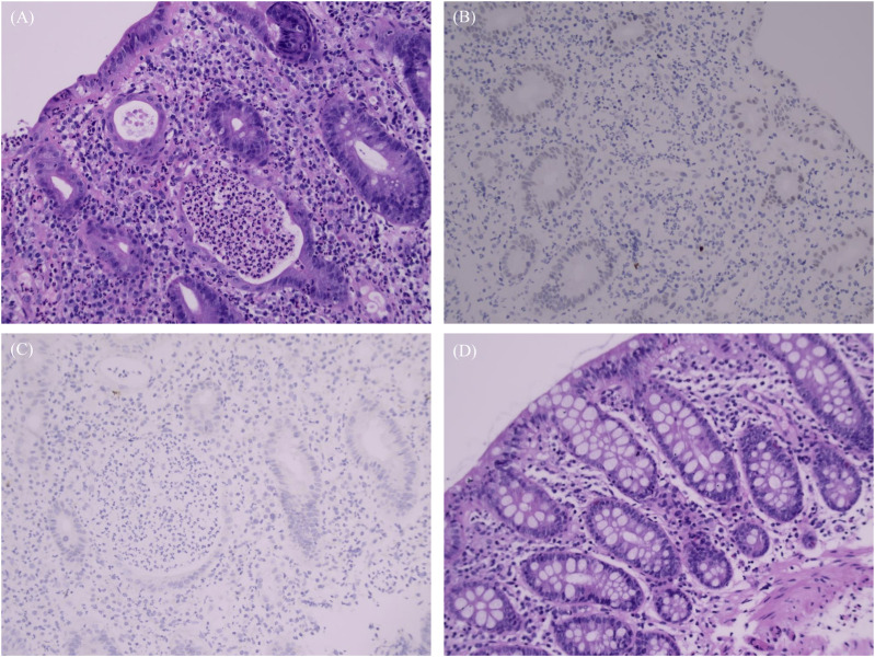 Case report: Alectinib-associated intestinal ulceration and colitis in a patient with non-small cell lung cancer and effective treatment with Mesalazine.