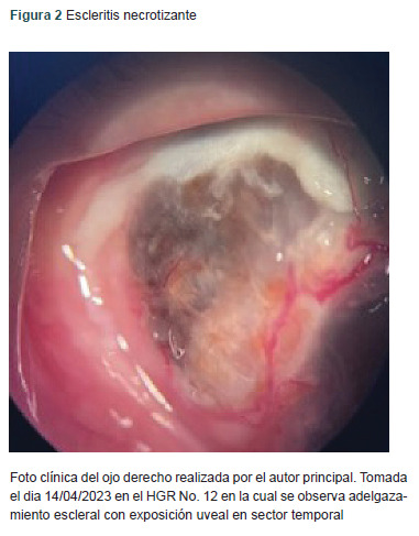 [Peripheral ulcerative keratitis with necrotizing scleritis, manifestation of granulomatosis with polyangiitis].