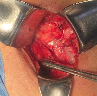 Clinical Presentation and Surgical Management of a Grynfelt Hernia: Report of a Clinical Case and Literature Review.