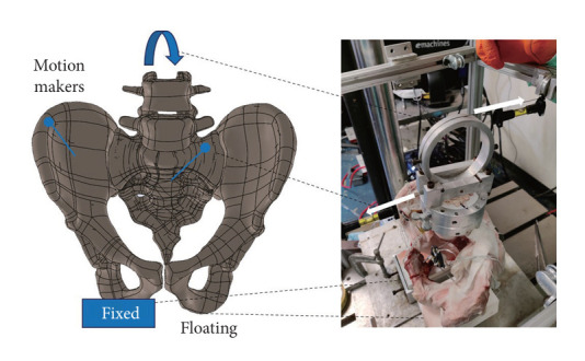 Fixation of the Sacroiliac Joint: A Cadaver-Based Concurrent-Controlled Biomechanical Comparison of Posterior Interposition and Posterolateral Transosseous Techniques.