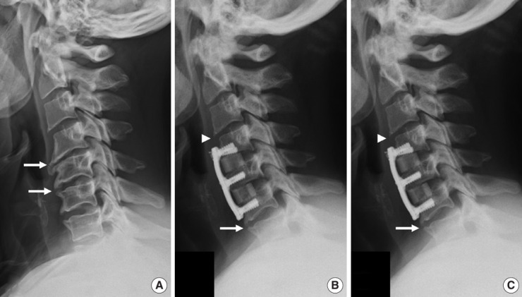 Risk Factors for "Adjacent-Level Ossification Development" Other Than Short Plate-to-Disc Distance and Clinical Implications for Adjacent-Segment Pathology.