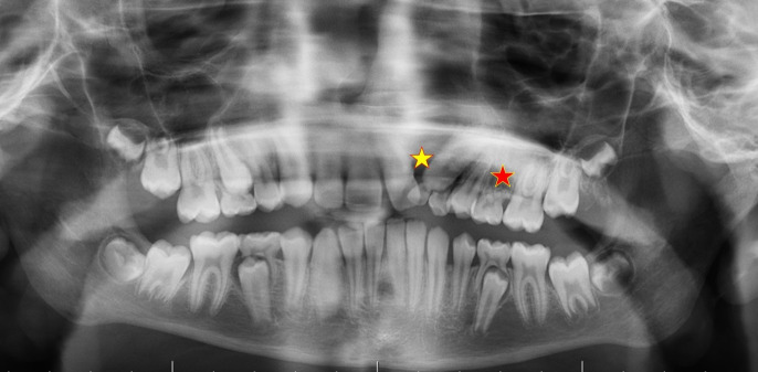 Retrospective Evaluation of Tooth Agenesis in Different Regions of Turkey with Panoramic Radiography.