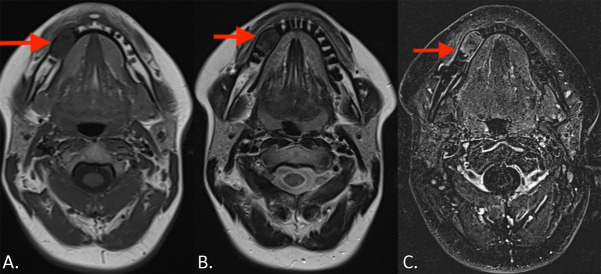 Mandibular Cemento‑ossifying Fibroma.