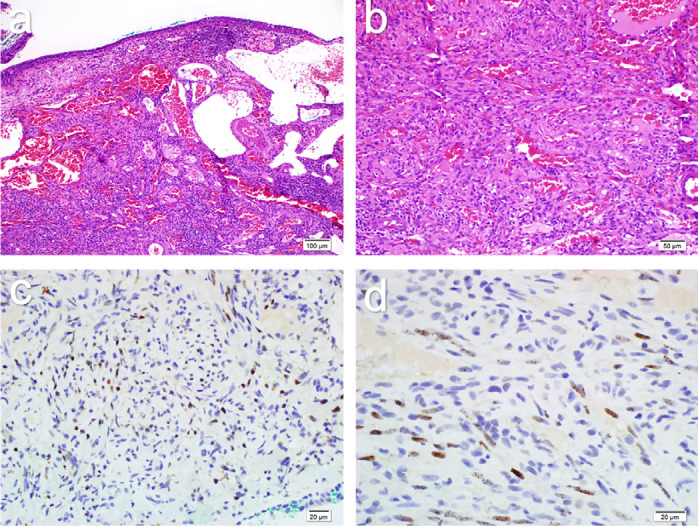 Ocular Manifestations of Kaposi Sarcoma: Insights from an HIV-Positive Patient and an Immunocompetent HIV-Negative Patient.
