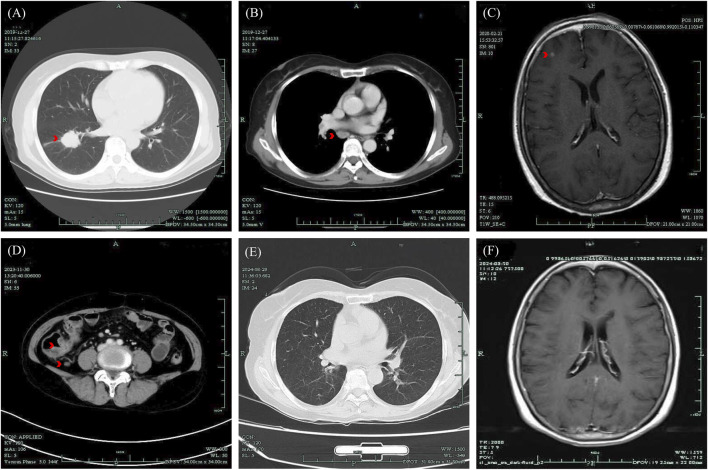 Case report: Alectinib-associated intestinal ulceration and colitis in a patient with non-small cell lung cancer and effective treatment with Mesalazine.