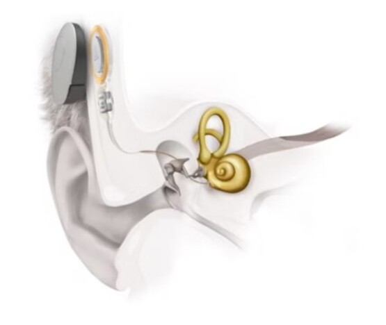 Effect of active middle ear implant on auditory speech perception in individuals with ear malformation.