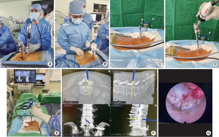 The Utilization of Navigation and Emerging Technologies With Endoscopic Spine Surgery: A Narrative Review.