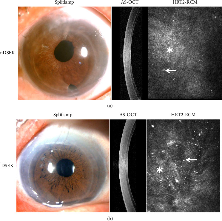 Comparison and Correlation of the Donor-Recipient Interface Changes and Visual Outcomes Between nDSEK and DSEK.