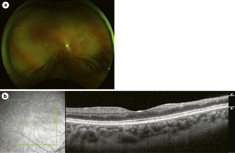 Ipsilateral, Multi-Phasic Retinal Vascular Events following Intralesional Triamcinolone Acetonide Injection for Earlobe Keloid: A Case Report.