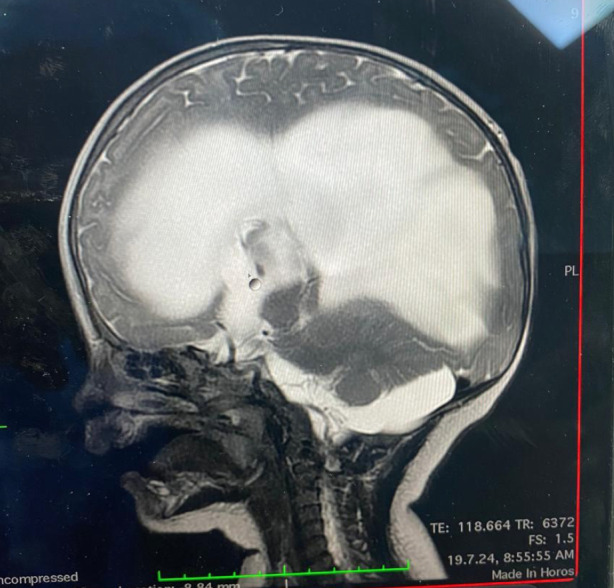 Anaesthesia Considerations on Paediatric Neurosurgery.