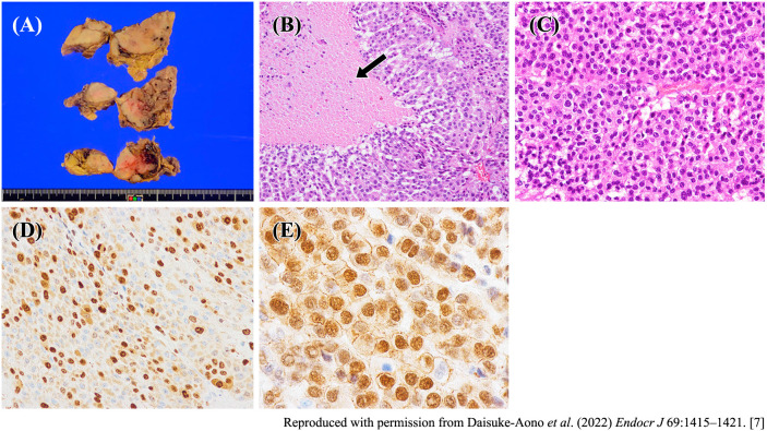 Adrenocortical carcinoma with circulating tumor DNA analysis at post-operative recurrence: a case report with review of literature.