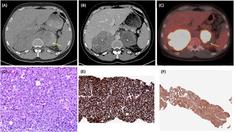 Diffuse large B-cell lymphoma presenting as acute adrenal hemorrhage.