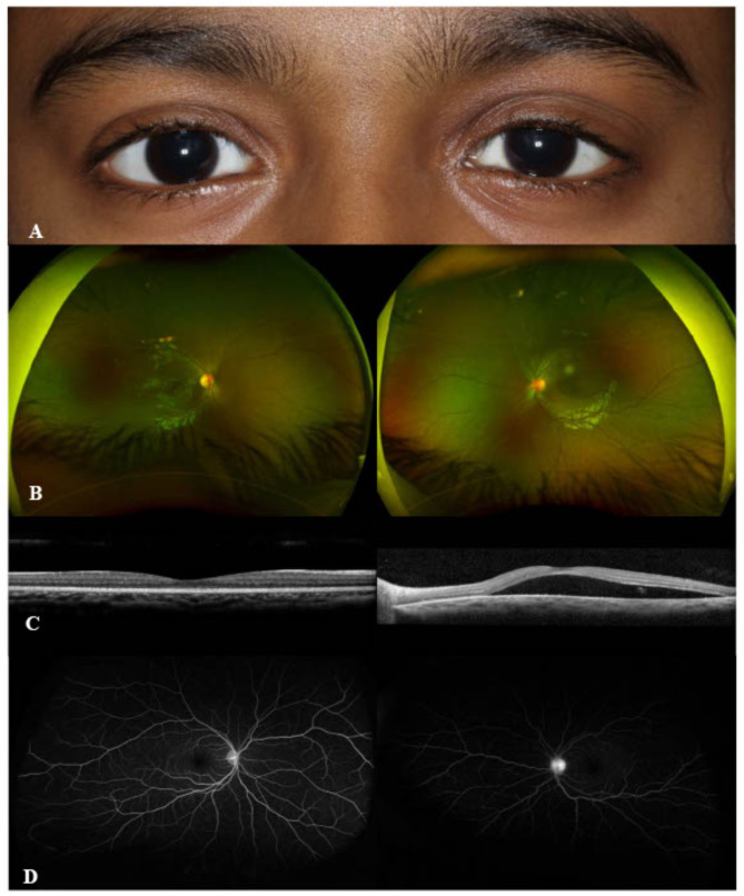 IgG4-related ophthalmic disease presenting as posterior scleritis in a pediatric patient.