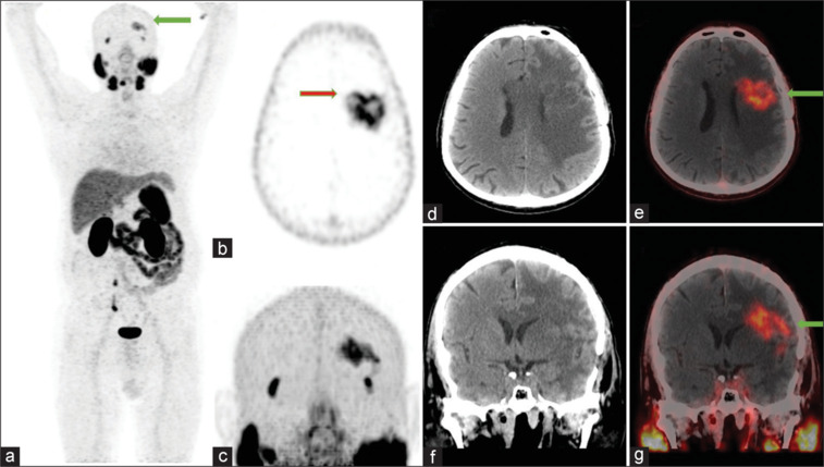 <sup>68</sup>Ga-PSMA PET/CT in a case of recurrent Glioblastoma.